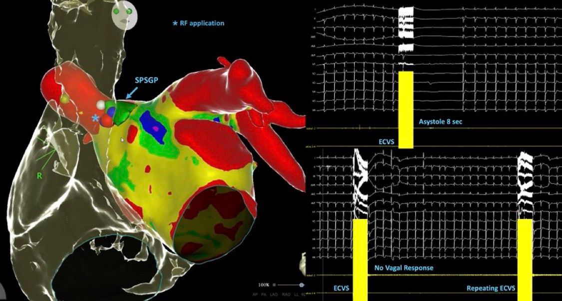 Applicazione di radiofrequenza al ganglio SPSGP durante cardioneuroablazione con verifica dell'endpoint tramite stimolazione vagale extracardiaca (ECVS): risposta pre-ablazione (asistolia 8 sec) e post-ablazione (nessuna risposta vagale)
