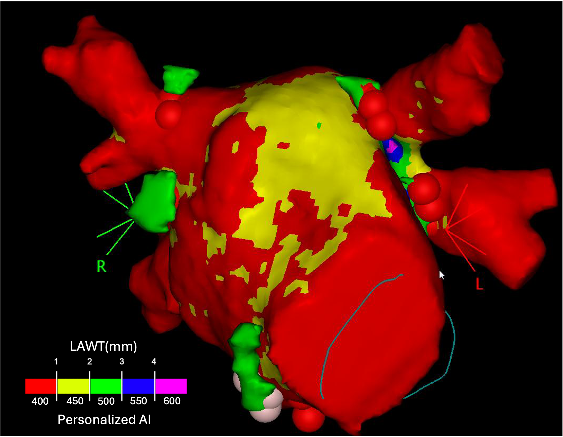 Mappa 3D del cuore con analisi personalizzata dello spessore della parete atriale sinistra (LAWT) tramite AI, utilizzata per la pianificazione pre-procedurale della cardioneuroablazione