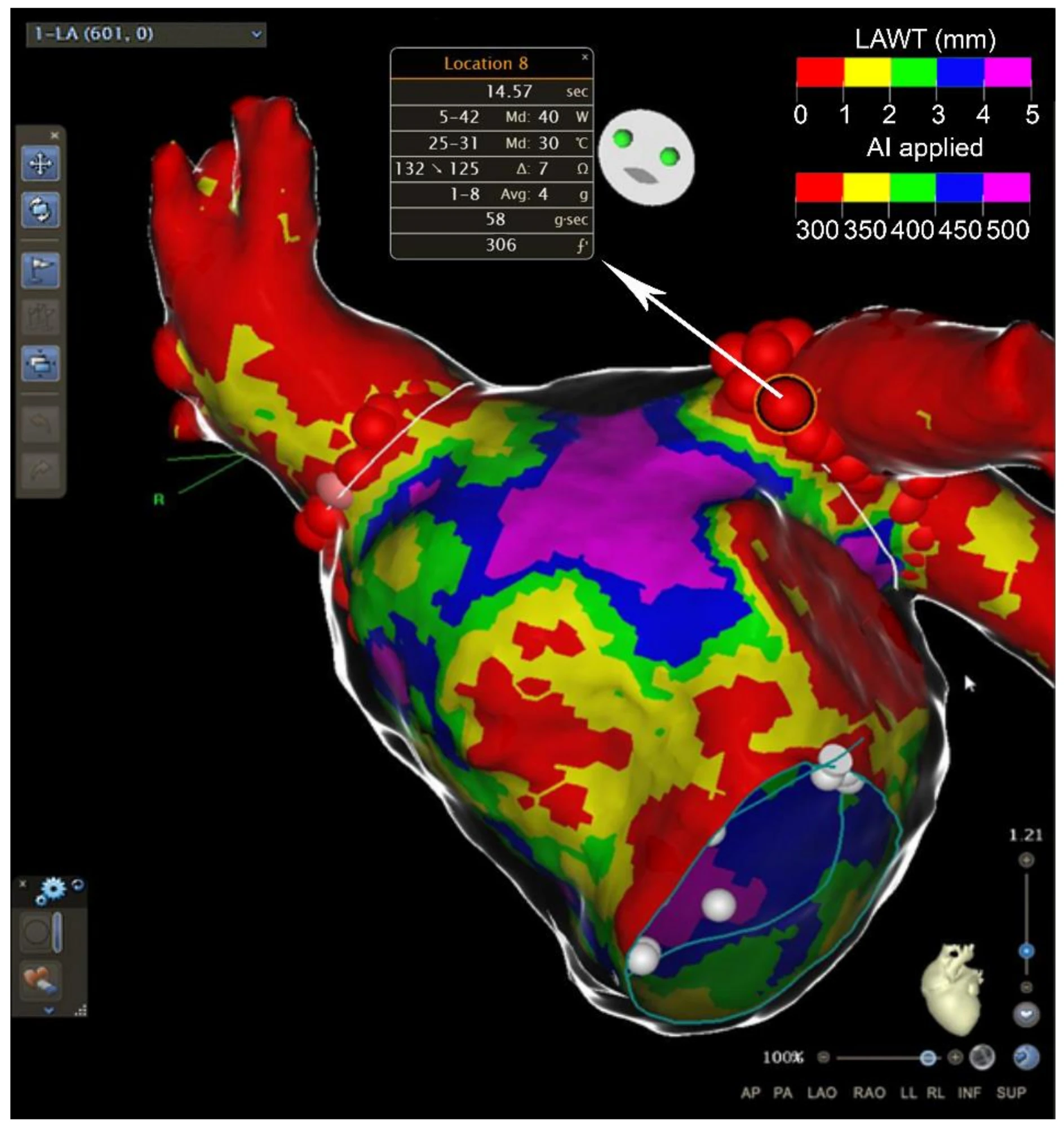 Mappa 3D del cuore con analisi personalizzata dello spessore della parete atriale sinistra (LAWT) tramite AI, utilizzata per la pianificazione pre-procedurale della cardioneuroablazione