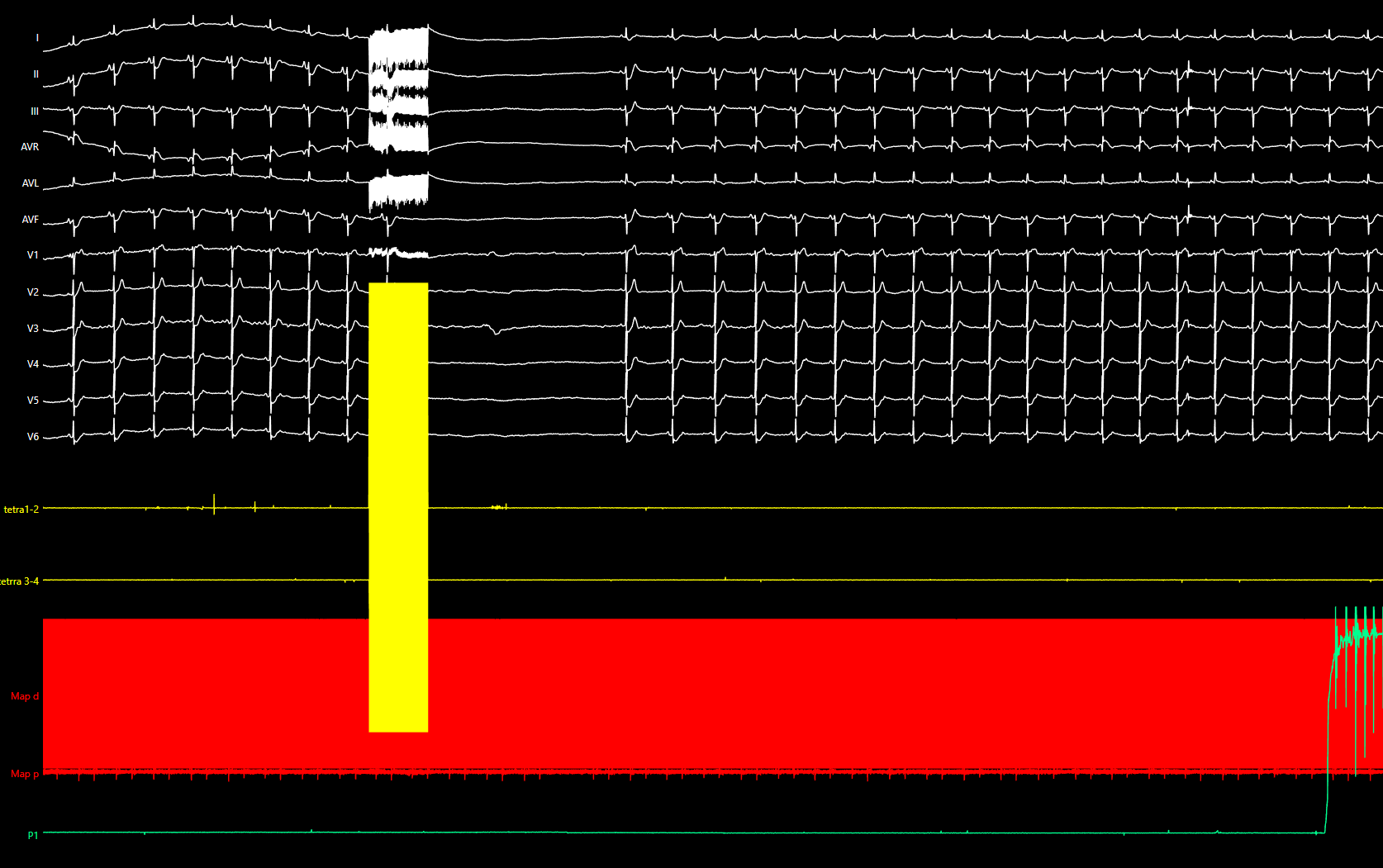 Registrazione elettrofisiologica pre-ablazione: risposta vagale durante stimolazione vagale extracardiaca (ECVS) con pausa sinusale prolungata, documentazione dell'indicazione alla cardioneuroablazione